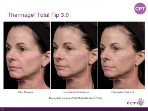 Thermage Total Tip Sales Presentation-Page-22